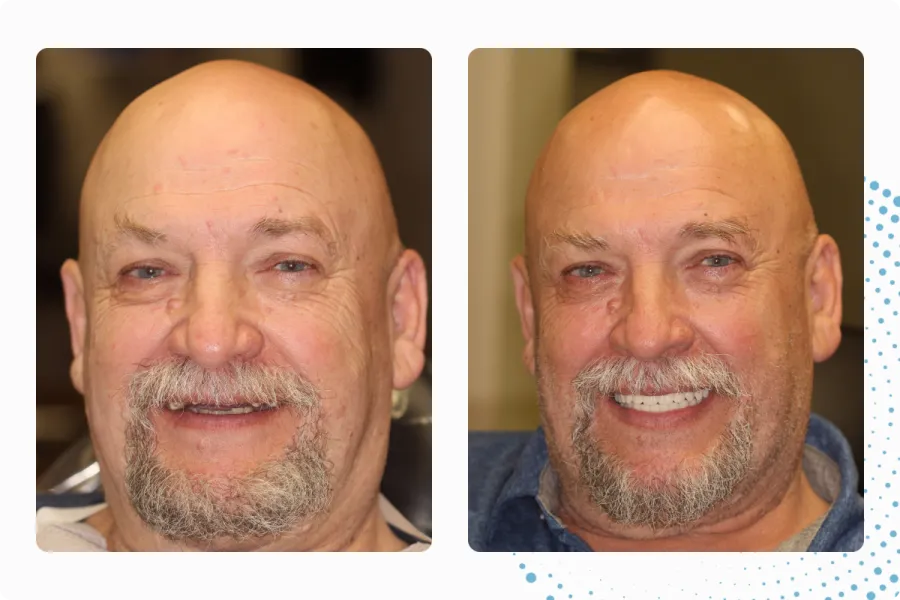 Before and after full arch treatment, patient one
