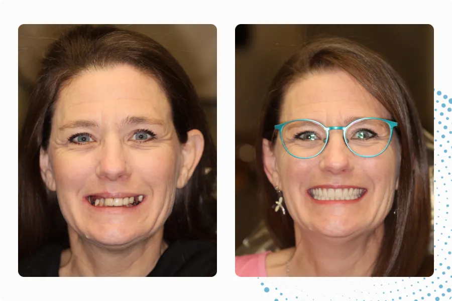 Before and after full arch treatment, patient two