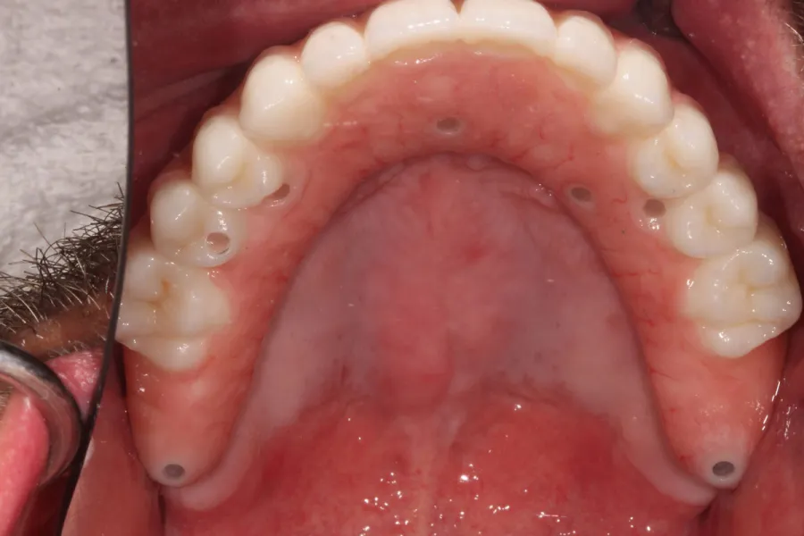 An upper arch of final full zirconia teeth fixed in place on implants