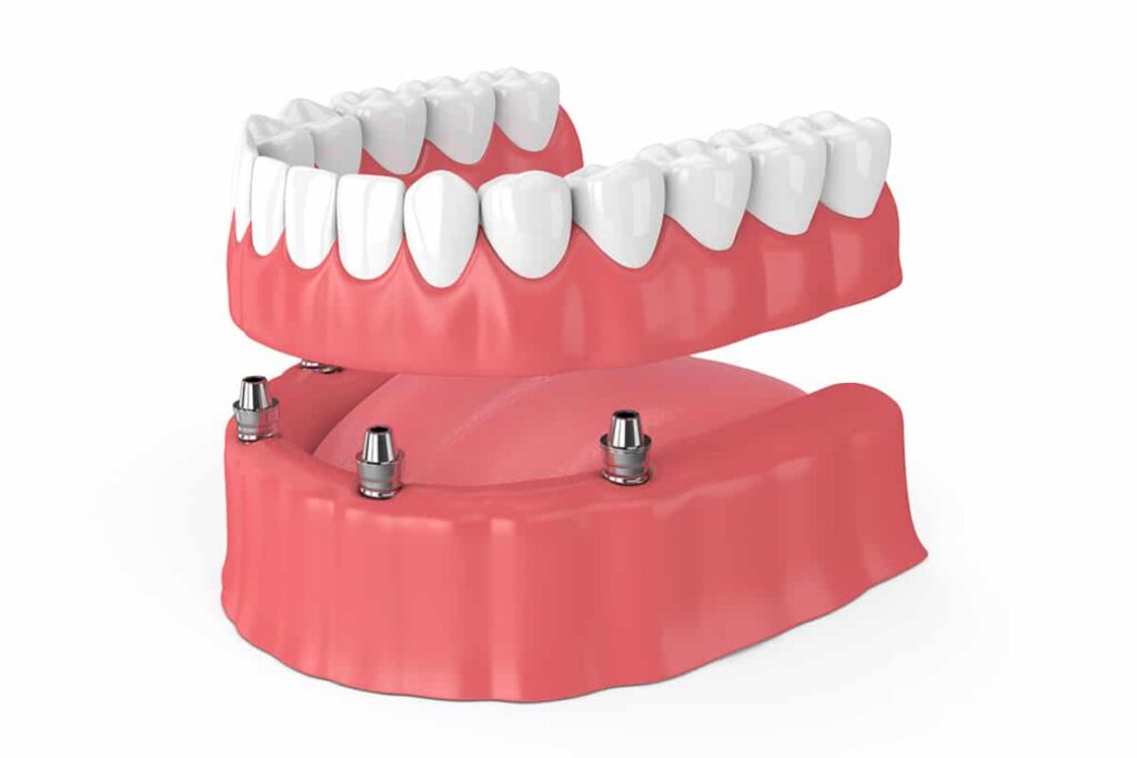 Permanent Implant Dentures Illustration