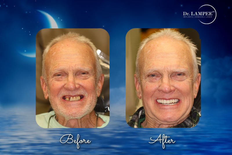 bill teeth in a day before and after