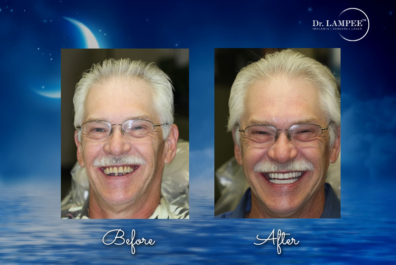 mel combined implant supported dentures