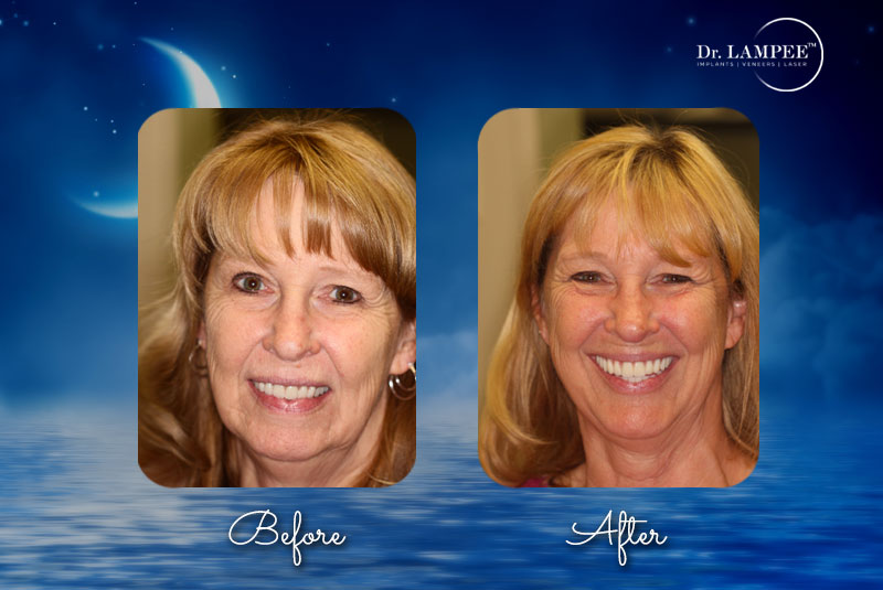 thela dental implants combined