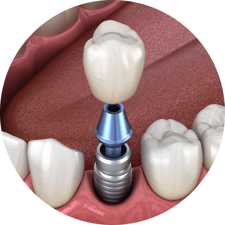 Single Dental Implants Model