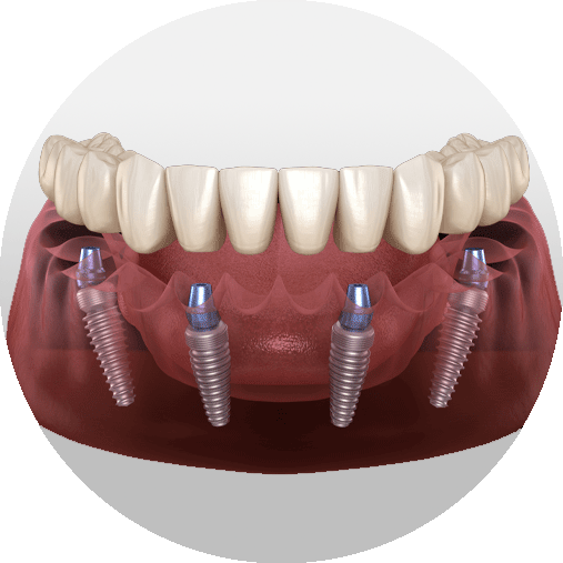 All-On-4 Dental Implants Model