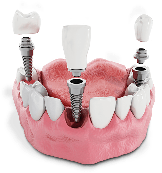 Multiple Single Dental Implant Model