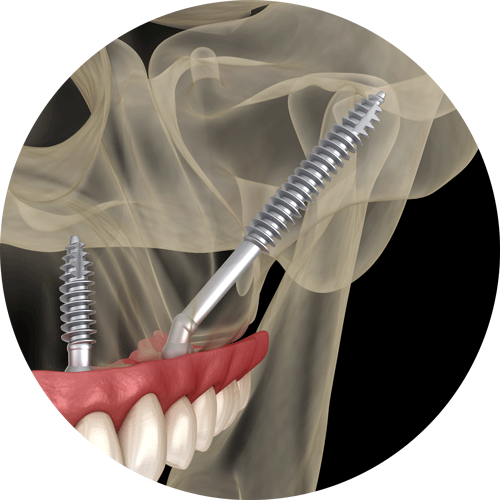 Zygomatic Dental Implant In Patient's Jaw Graphic
