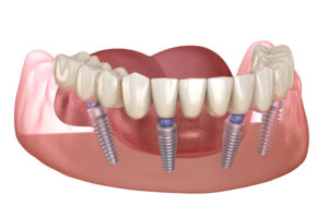 a graphic image of All-On-4 dental implants that shows how the four dental implants support a full arch prosthesis.