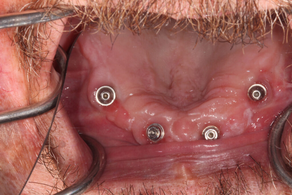 zygomatic implants in the mouth