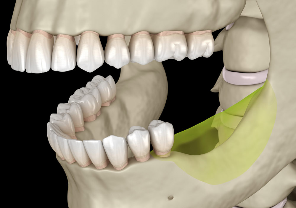 Bone loss in jaw from missing teeth