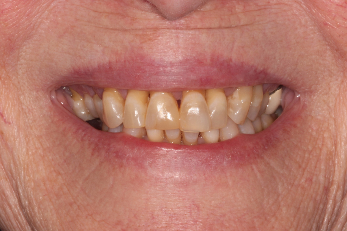 After dental treatment